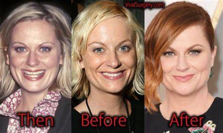 Amy Poehler Plastic Surgery Before and After Botox Injections