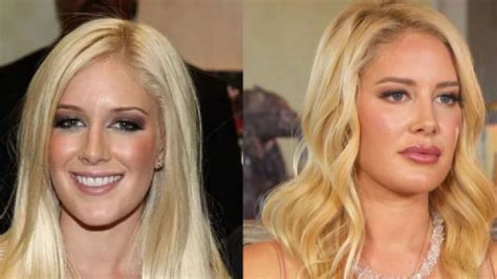 Heidi Montag Plastic Surgery Before and After